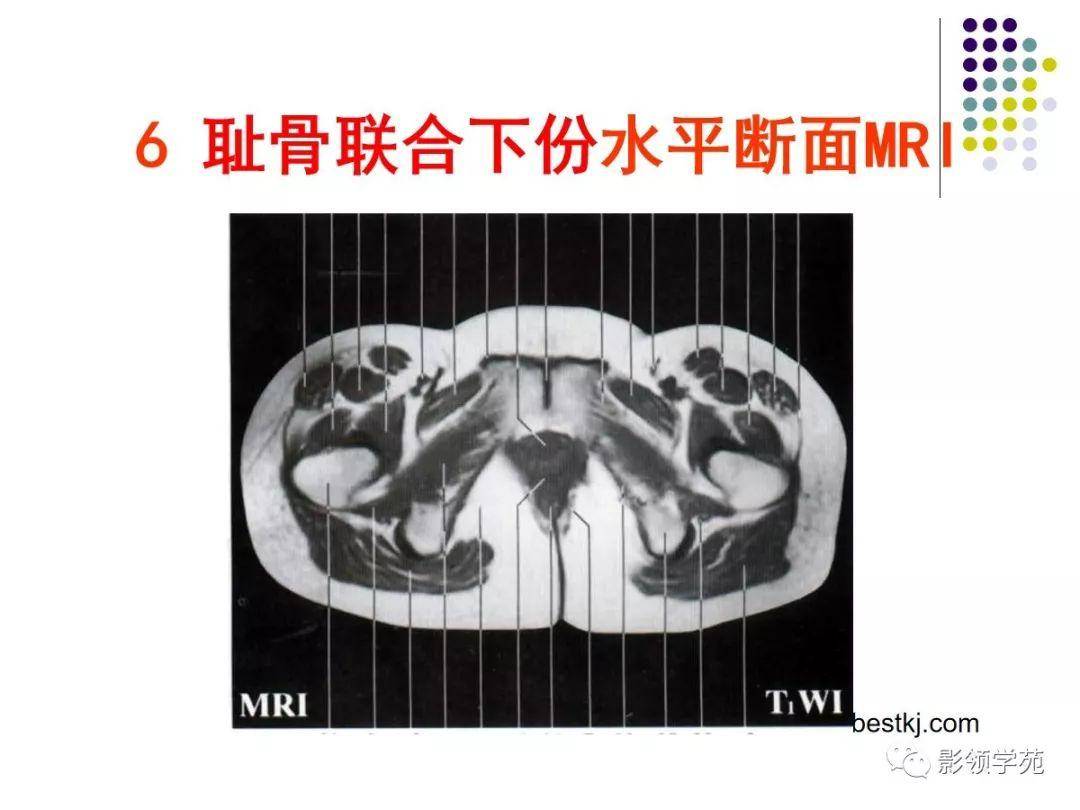 女性盆腔水平断面解剖图谱,ct及mri女性盆腔的典型横断面解剖女性盆腔