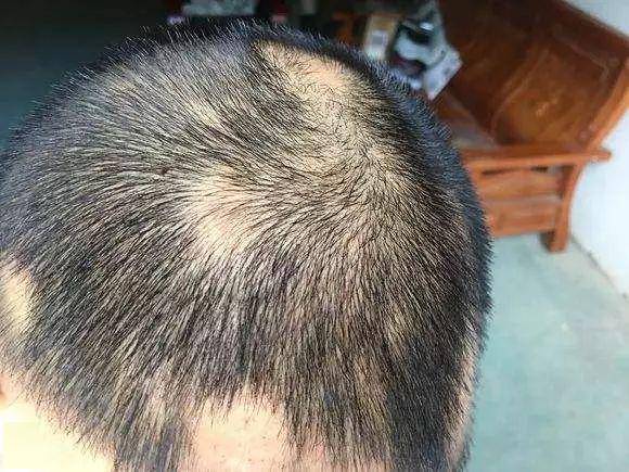 斑秃是突然发生的局限性斑片状脱发,因为一般发生在夜间,也被称为"