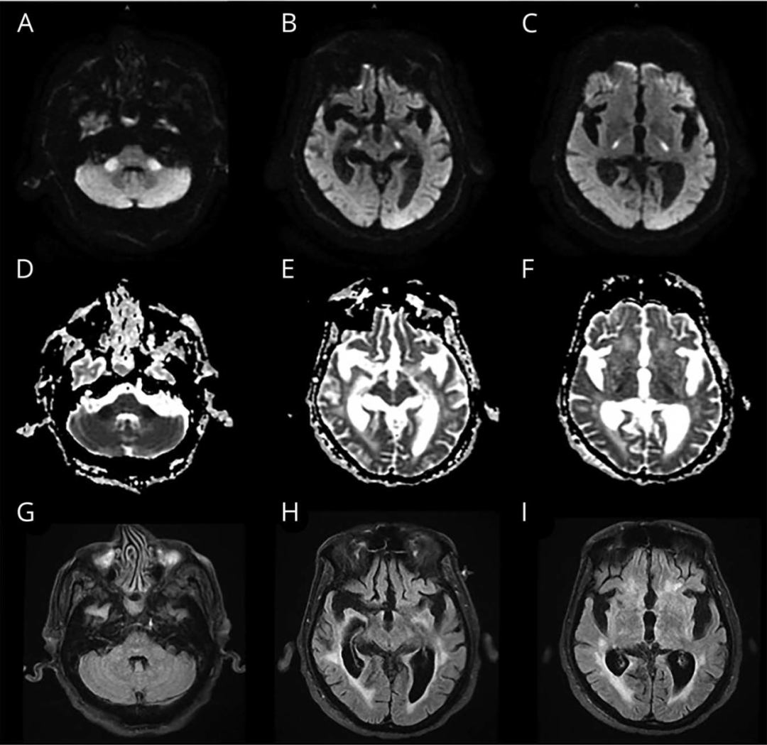 neurology:高钠血症患者的桥外渗透性脱髓鞘1例