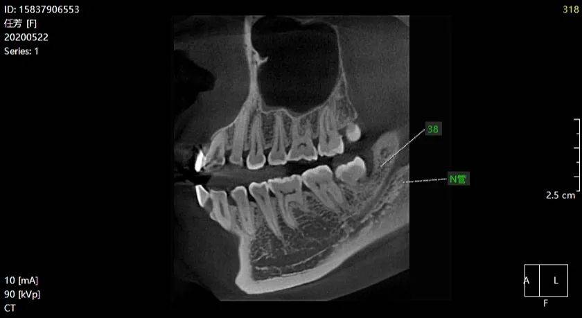 cbct示:38垂直低位,双根,根尖偏舌侧,均未压迫同侧下颌神经管返回搜狐