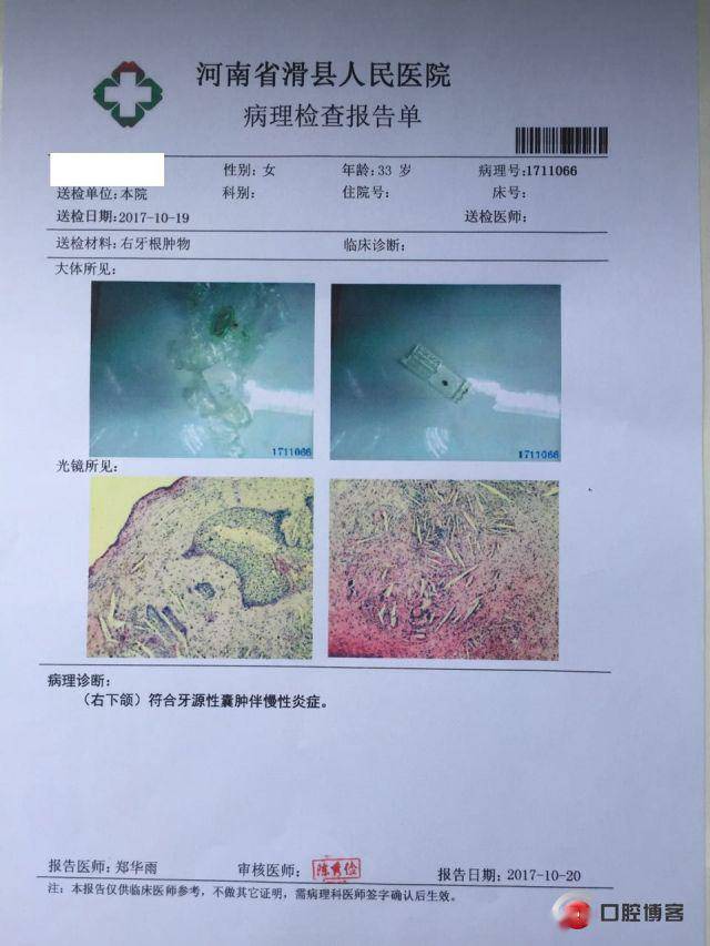 从微创到精准后牙根尖囊肿摘除根管倒充填手术