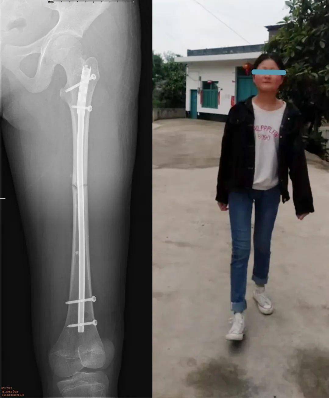 關注14歲少女摔斷大腿術後當晚竟