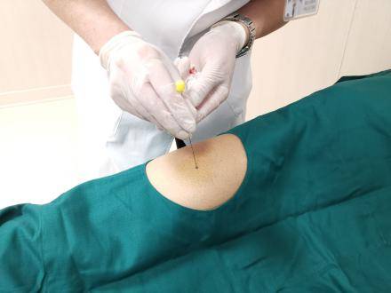 痛苦小效果好康复科穴位埋线疗法正式上线啦患者福音