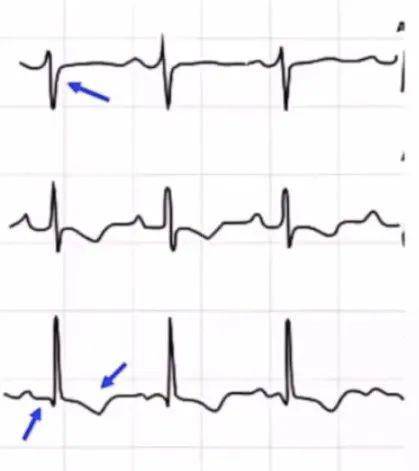急性肺栓塞心电图特征图片