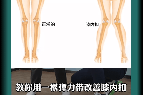 放大招了一个弹力带调整膝内扣你学会了吗