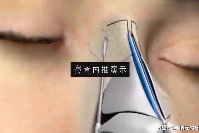 鼻骨宽应不该做鼻骨内推 医生 鼻骨宽应不该做鼻骨内推 医生