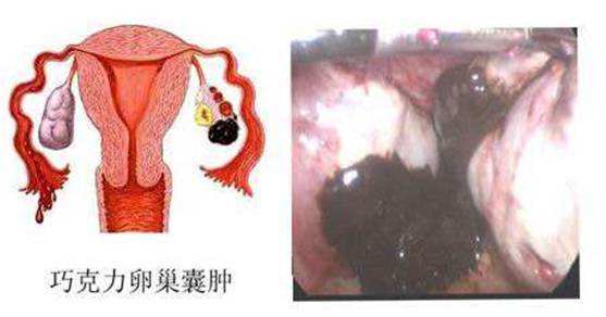 享生宝:巧克力囊肿会影响做试管吗?