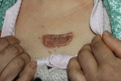 疤康效果怎么样案例来说话