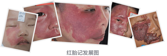 河北省中医院红胎记有哪些症状表现