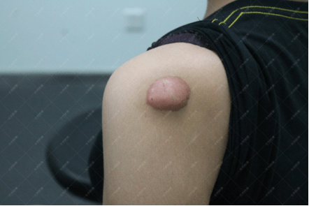 手术疤痕痒怎么处理 bf82f052523e4965b9aacb56f44bbe24.png