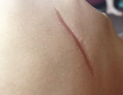 胥肖琴医生陈旧老疤怎样才能祛除能修复到什么程度