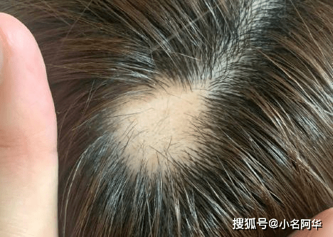 摆脱脱发困扰：新时代治疗新机遇