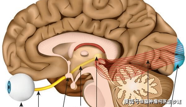 脑肿瘤为什么会引起视力下降_眼睛