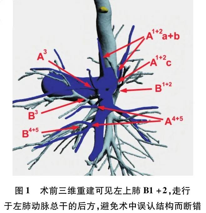 以最小代價救治肺癌患者,分享三家醫院精準肺段切除