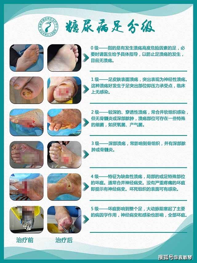 糖尿病足不一定都有伤口和感染,从轻到重有什么特征?_治疗