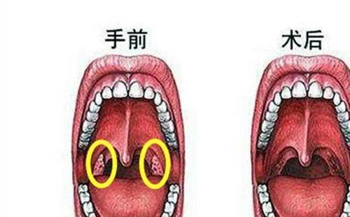 贵阳铭仁耳鼻喉医院:咽部有异物感是怎么回事?