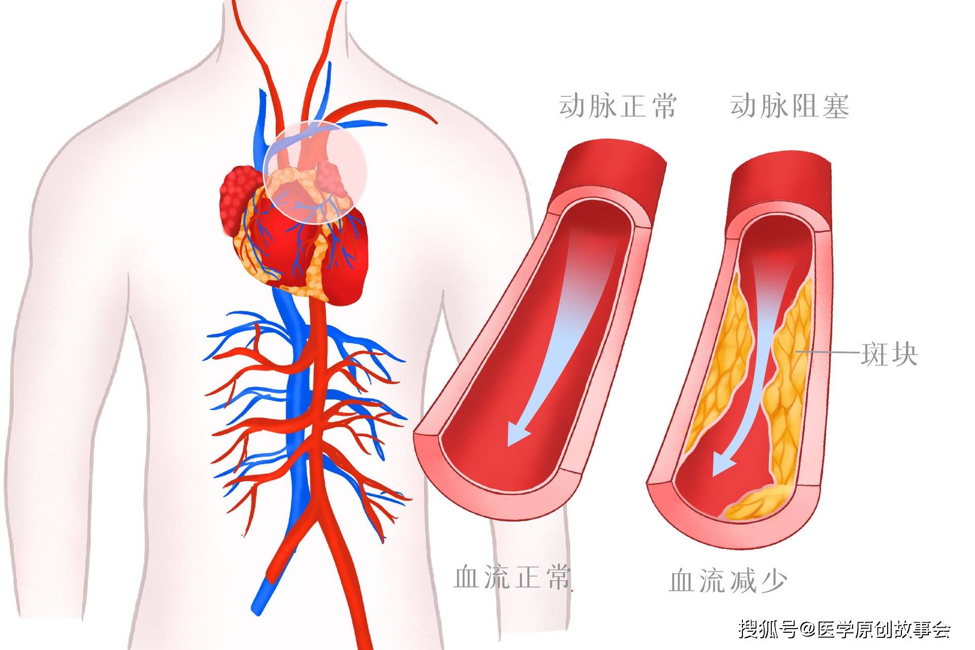 原创
别把心梗当成肩周炎,肩膀若有一个表现,可能是心脏在“求救”