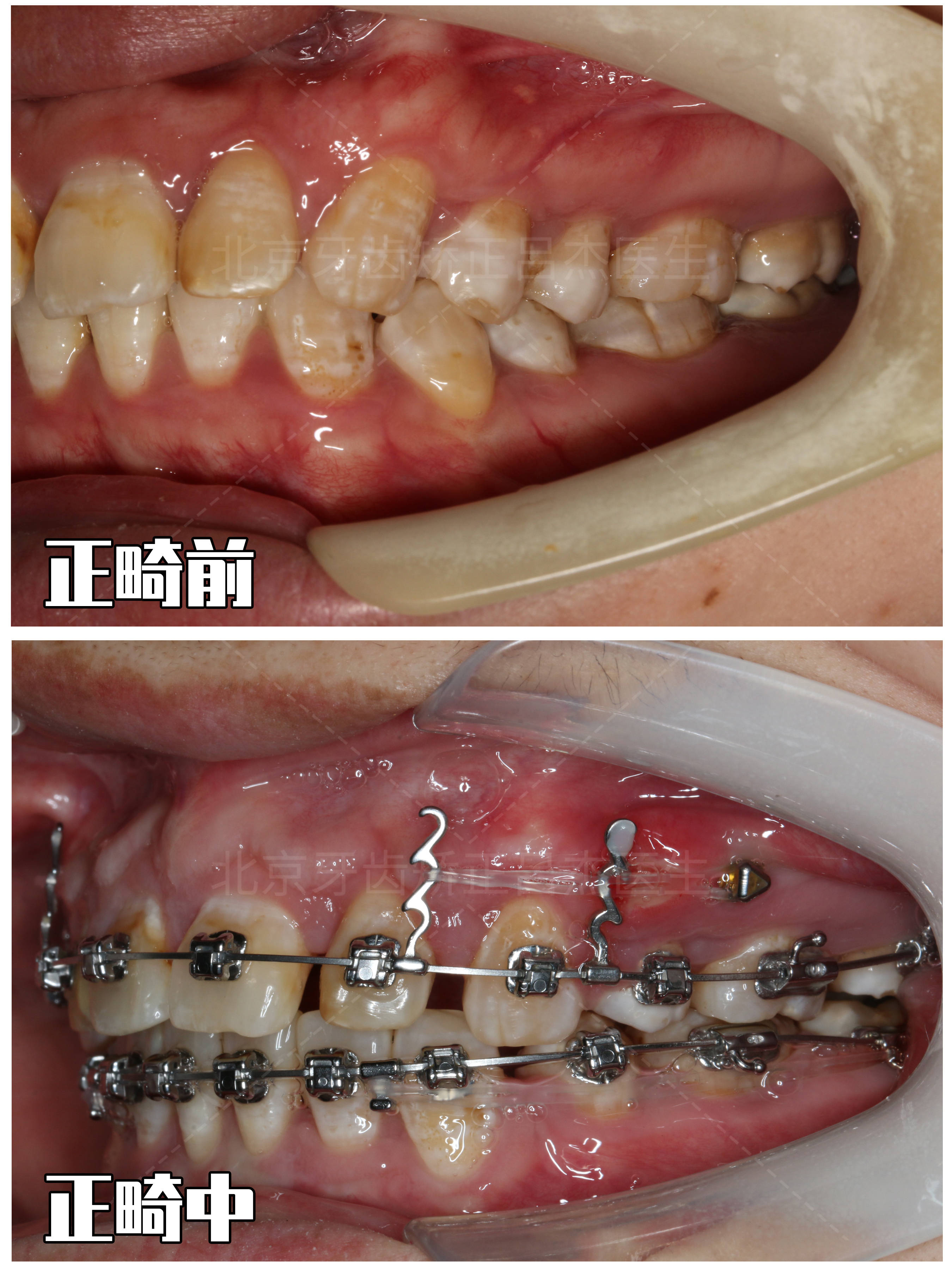北京牙齿矫正,双颌严重前突,还牙根短,怎么进行正畸?