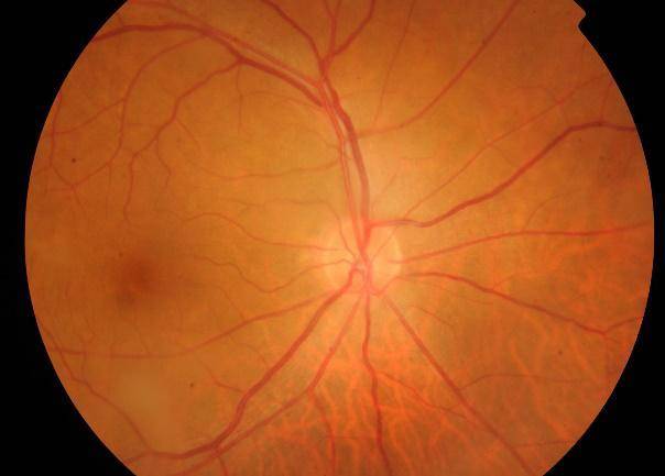 视网膜病变症状属于糖尿病视网膜病变得早,中期,在医学上称为非增殖