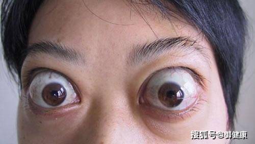 为什么会得甲亢甲减 68847b8c2db940f8b770198f5512033e.jpeg