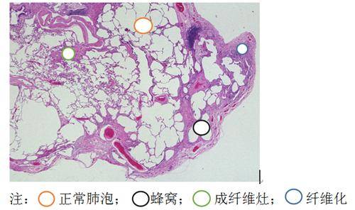 肺纤维化的危害有多大?