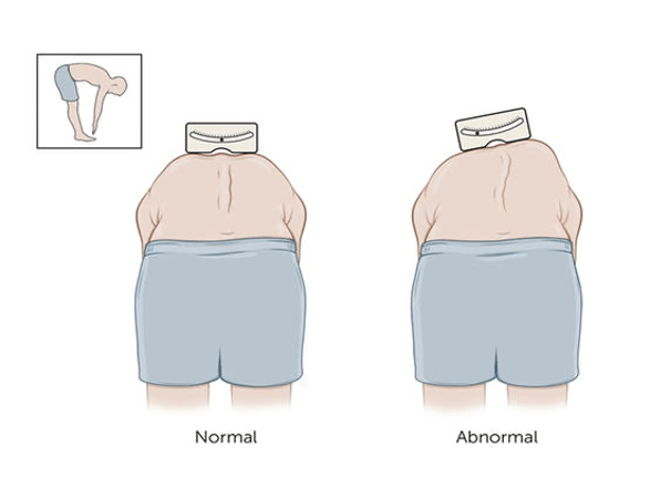 原创凯斯骨科知识含胸驼背小心可能是脊柱侧弯