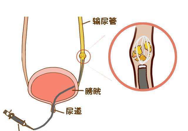 輸尿管結石的患者男的多還是女的多