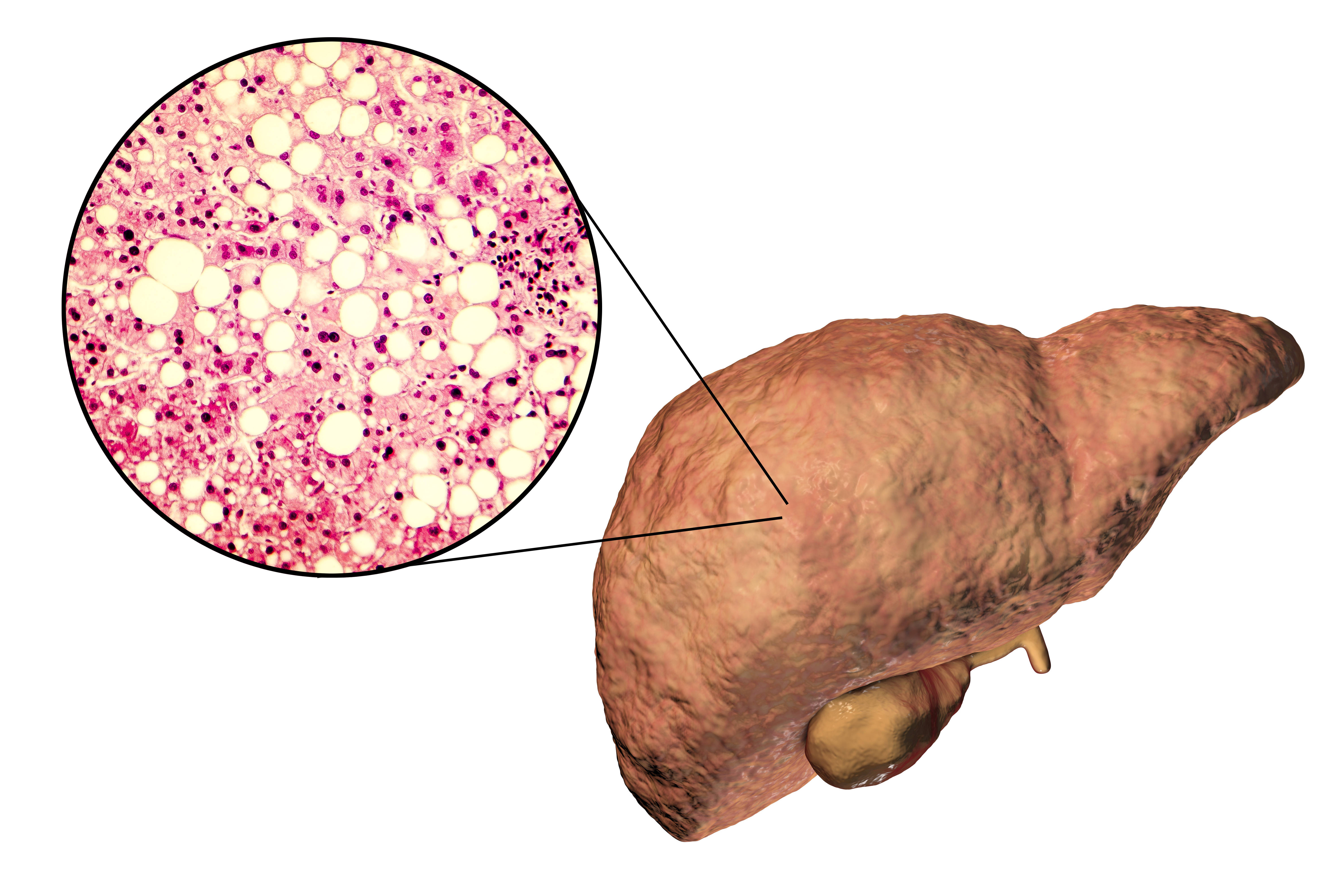 非酒精性脂肪性肝病( nafld )是脂肪肝家族中最常見的一種,於肥胖