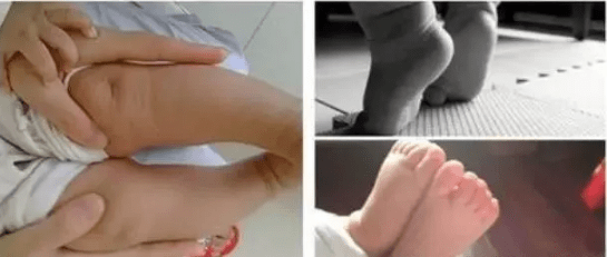 骨骼|脑瘫孩子足畸形与肌张力的关系