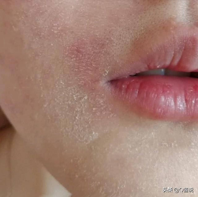 脂肪酸长期刺激皮肤毛囊,引发脂溢性皮炎,其症状为油腻性鳞屑或痂皮