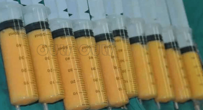 脂肪胶填充是永久的吗来看看