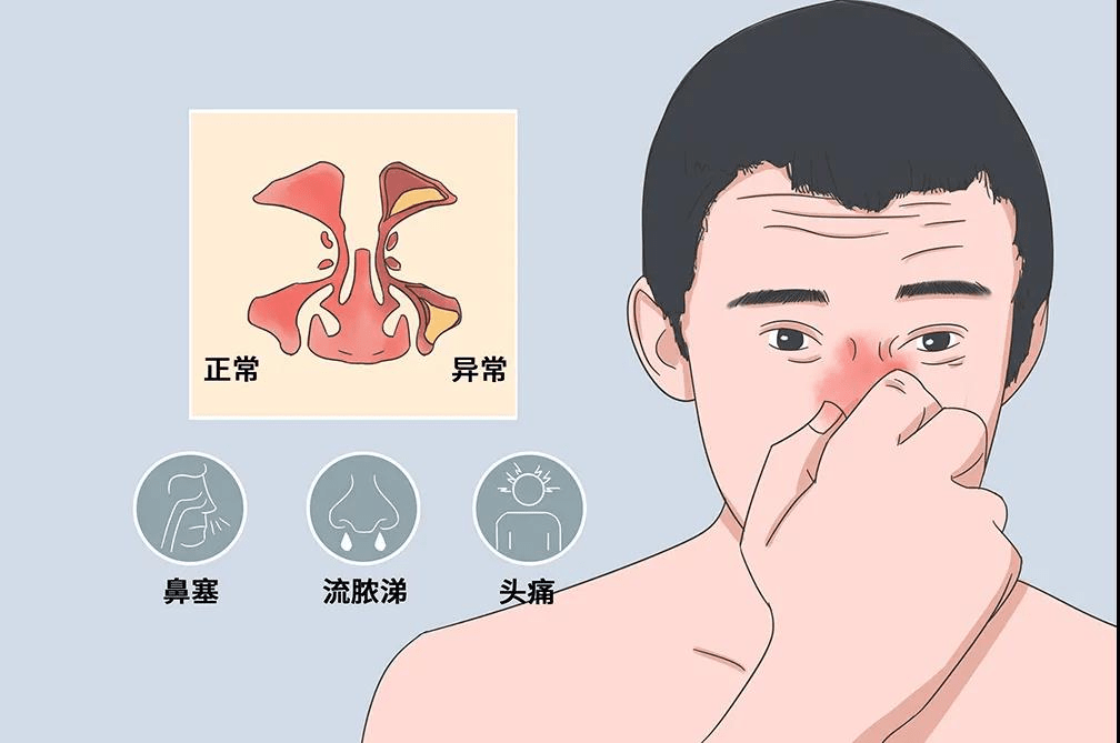鼻炎怎么治能除根（鼻炎多久可以治好）