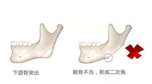 曲线|圣嘉新邱立东：下颌角截骨是否应该保留角度？