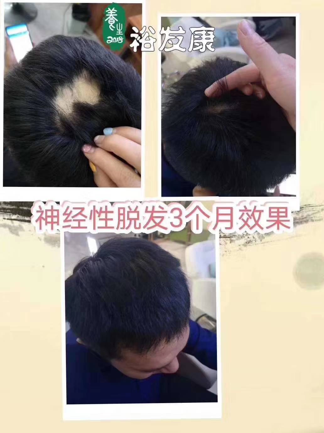 斑秃产生的原因有哪些呢