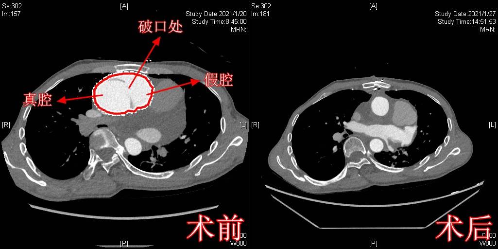 马凡|当心！你所羡慕的“魔鬼身材”可能是这种疾病发出的预警信号