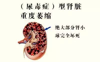 肾脏|干细胞 | 让尿毒症患者不再别无选择