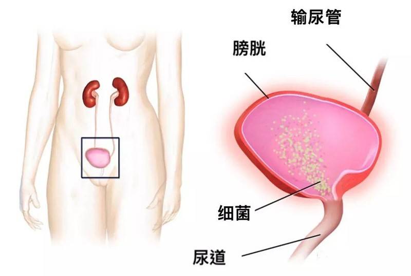 尿频尿急尿不尽怎么快速好 5cb914e9f1ed4c9c8d180d97ffa5ea9e.jpeg