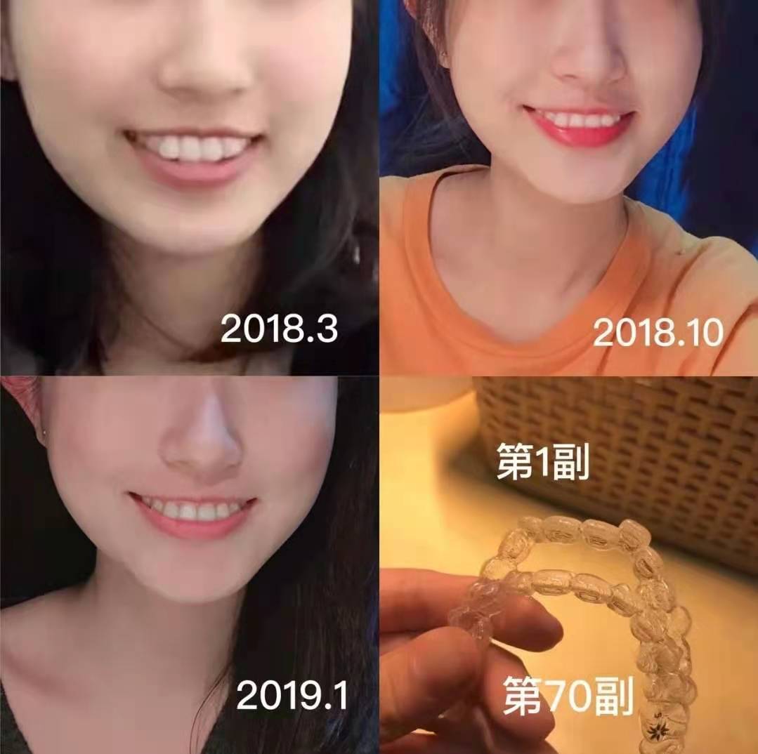 隐形牙套该如何佩戴摘取牙套新手看过来