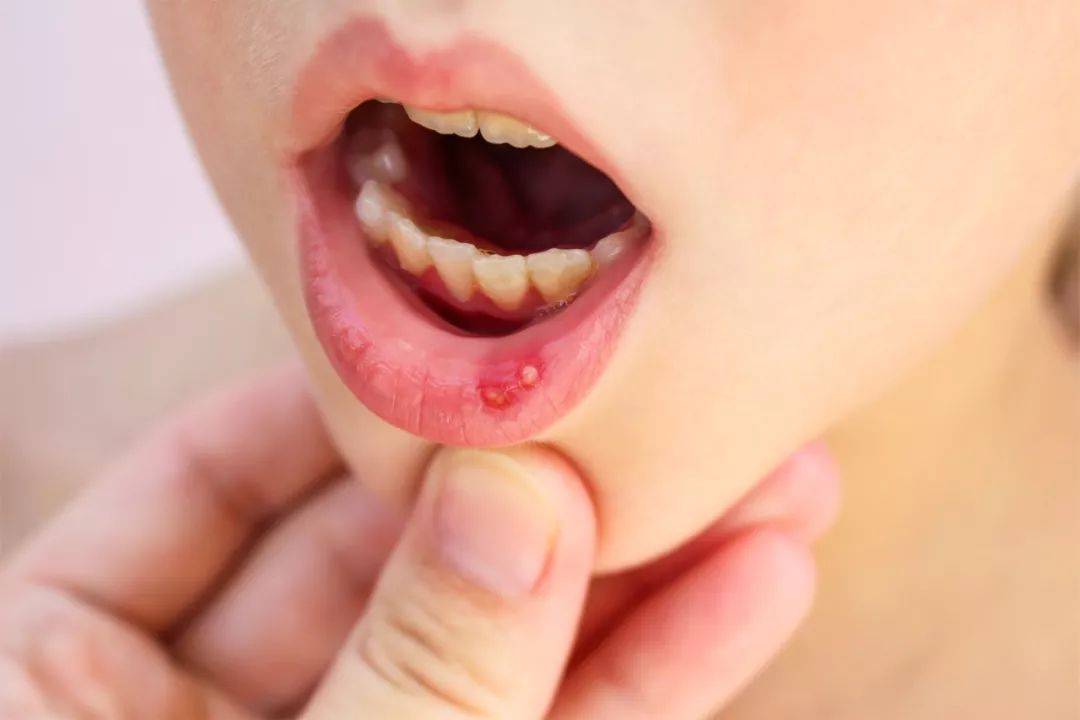 通常会长在唇内侧,口腔上颚和舌头等部位的黏膜上
