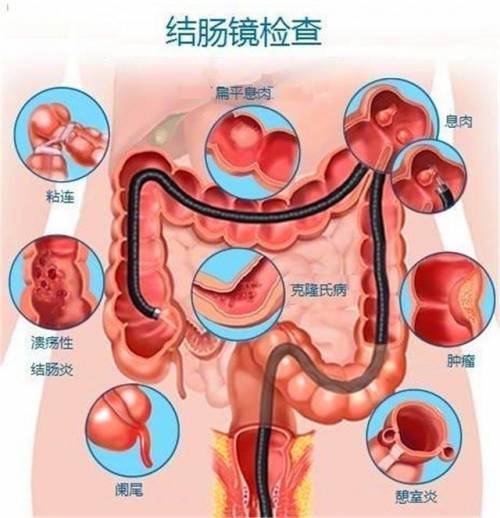 肠结核发病部位图片