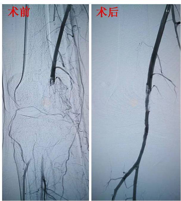 血栓|脉管炎微创治疗取得进展, 交大一附院血管外科再创西北首例