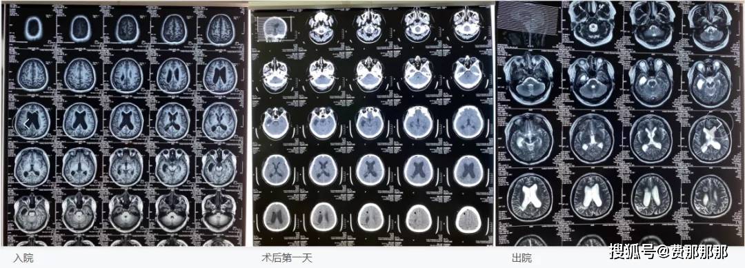 結果顯示腦室系統明顯擴大,右枕葉軟化灶,腦缺血性改變