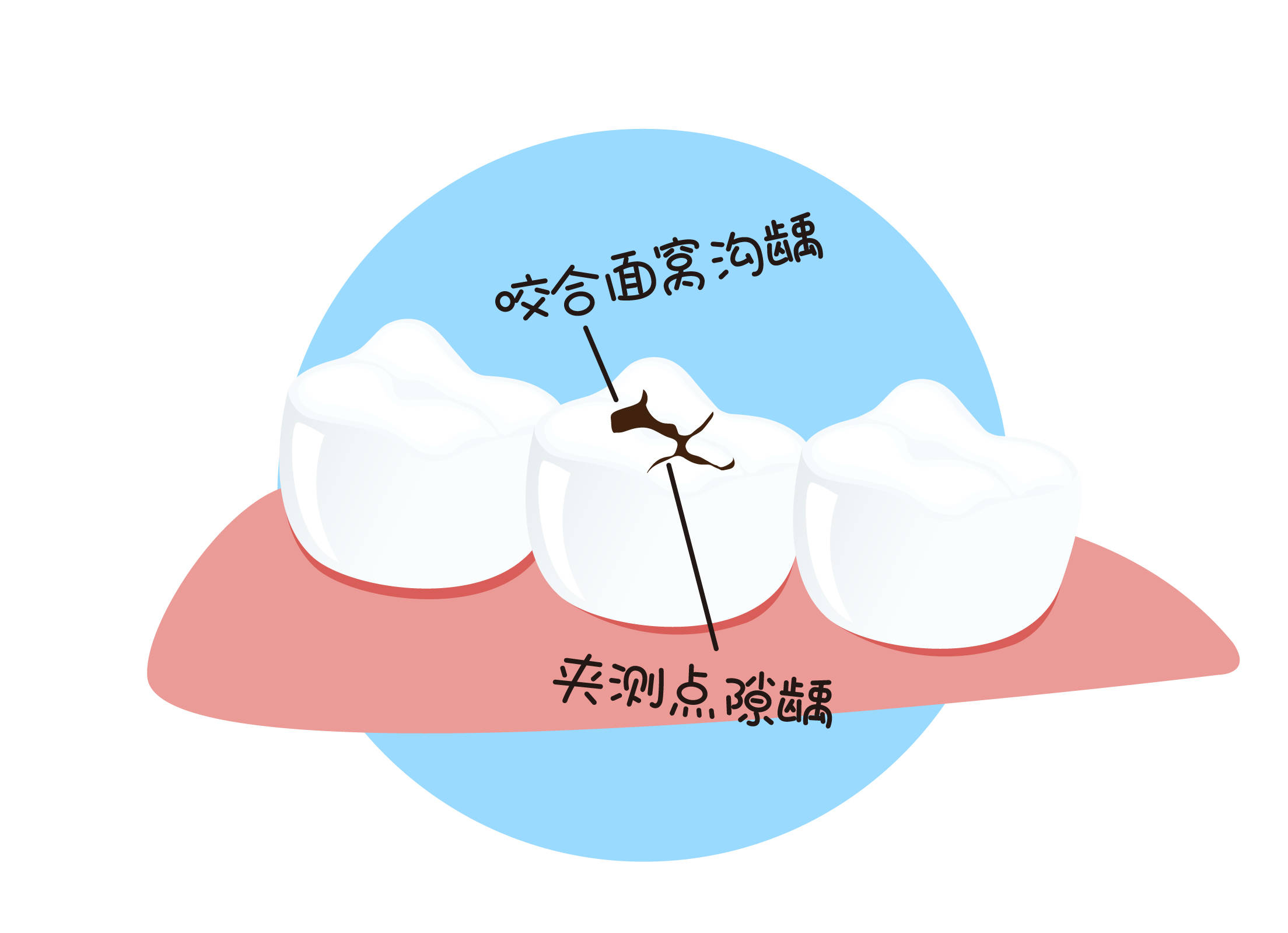 看牙补牙为什么这么贵原来是我错过了省钱的机会
