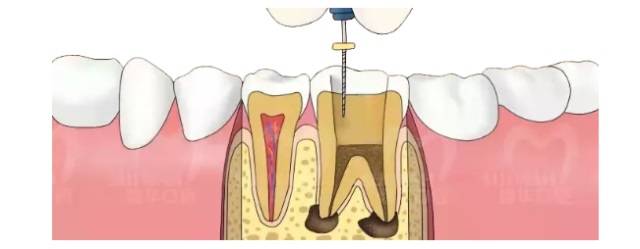 根管治療拯救判死刑的牙齒
