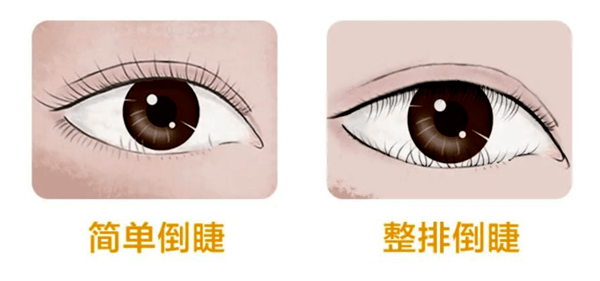 倒睫的危害:一根睫毛 也能影响整只眼睛!