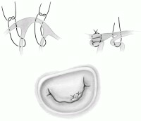 治疗|反复发烧2个多月，17岁女孩患的这种少见病经高难手术精巧治愈