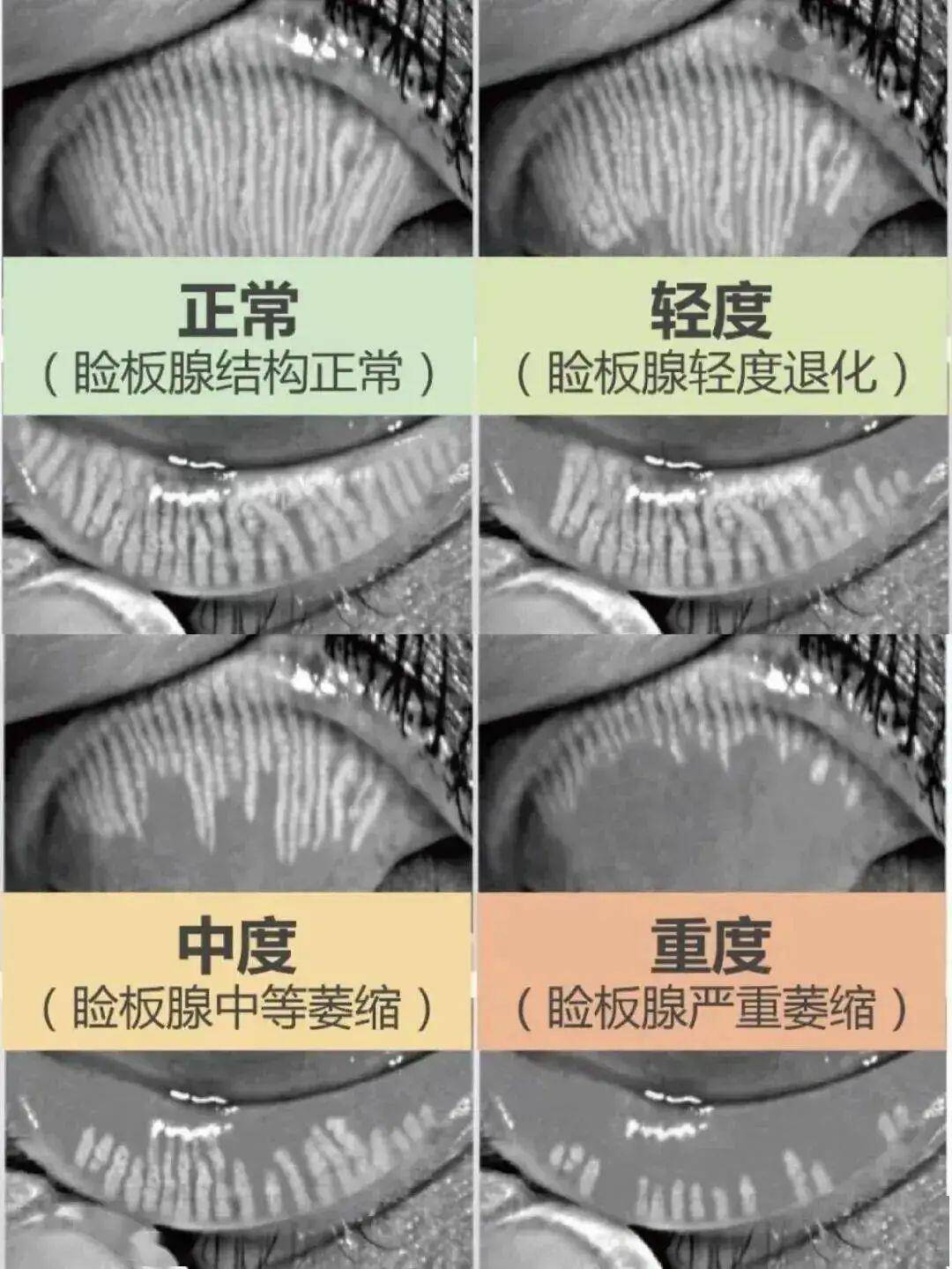 正常的睑板腺开口图片图片