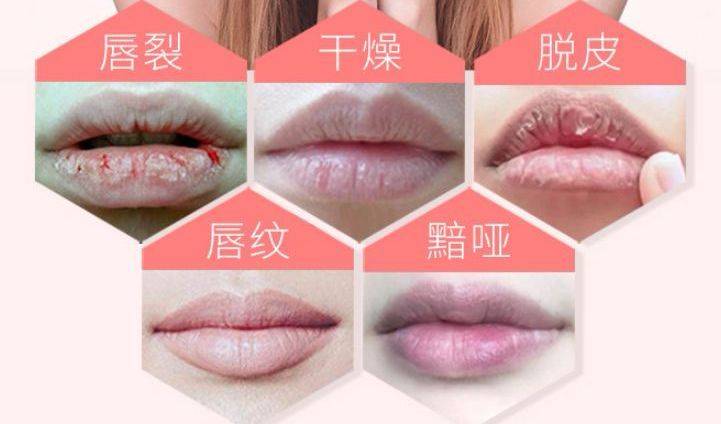 秋冬季嘴唇干,开裂怎么办?预防唇炎小技巧