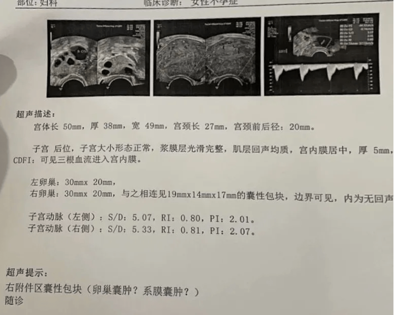 患上子宮內膜炎宮腔灌注瞭解一下