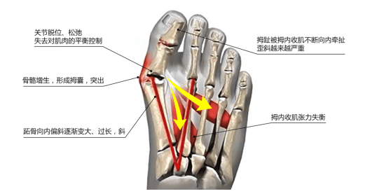 脚拇外翻怎么办